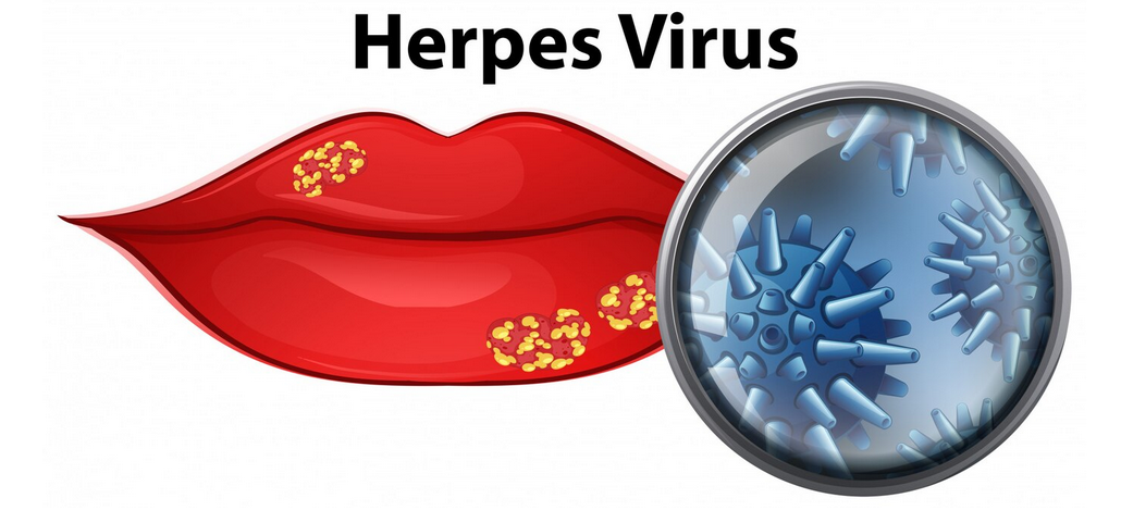 الهربس الفموي (قرحة الزكام)