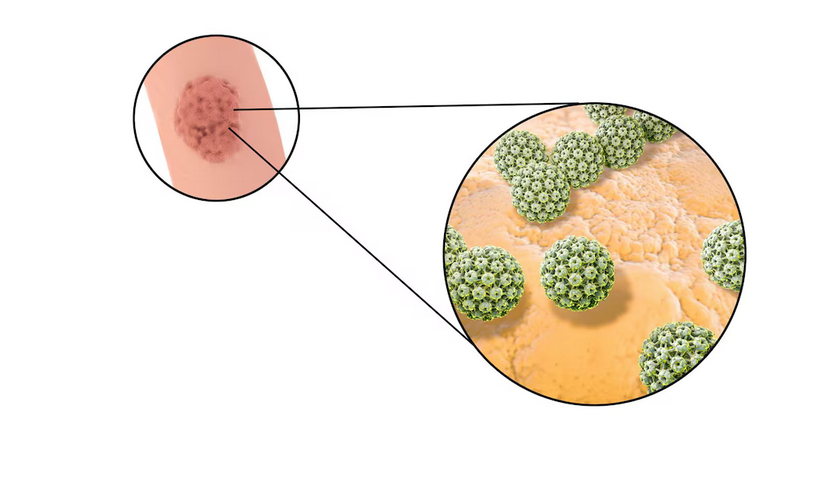 الثآليل التناسلية (فيروس الورم الحليمي البشري)