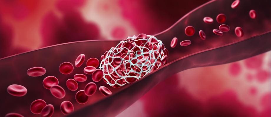 أسباب تجلط الدم وأعراضه وطرق العلاج: دليل شامل لفهم الحالة وطرق التعامل معها