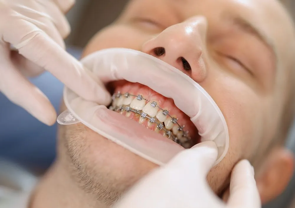 تقويم الأسنان بالرياض