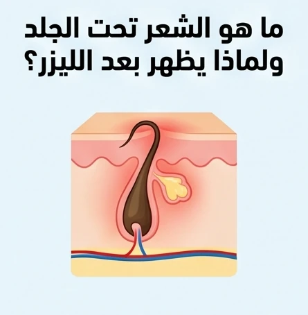 ما هو الشعر تحت الجلد ولماذا يظهر بعد الليزر؟
