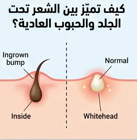 كيف تميز بين الشعر تحت الجلد والحبوب العادية؟