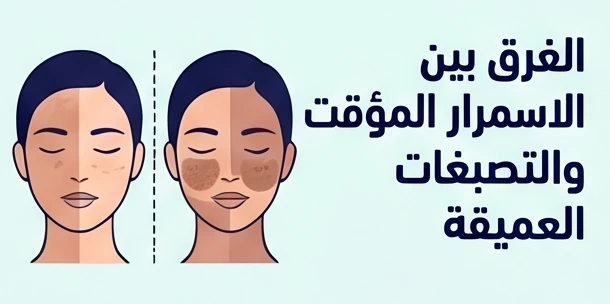 الفرق بين الاسمرار المؤقت والتصبغات العميقة