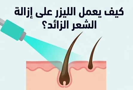 كيف يعمل الليزر على إزالة الشعر الزائد؟