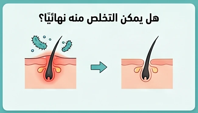 هل يمكن التخلص منه نهائيًا؟