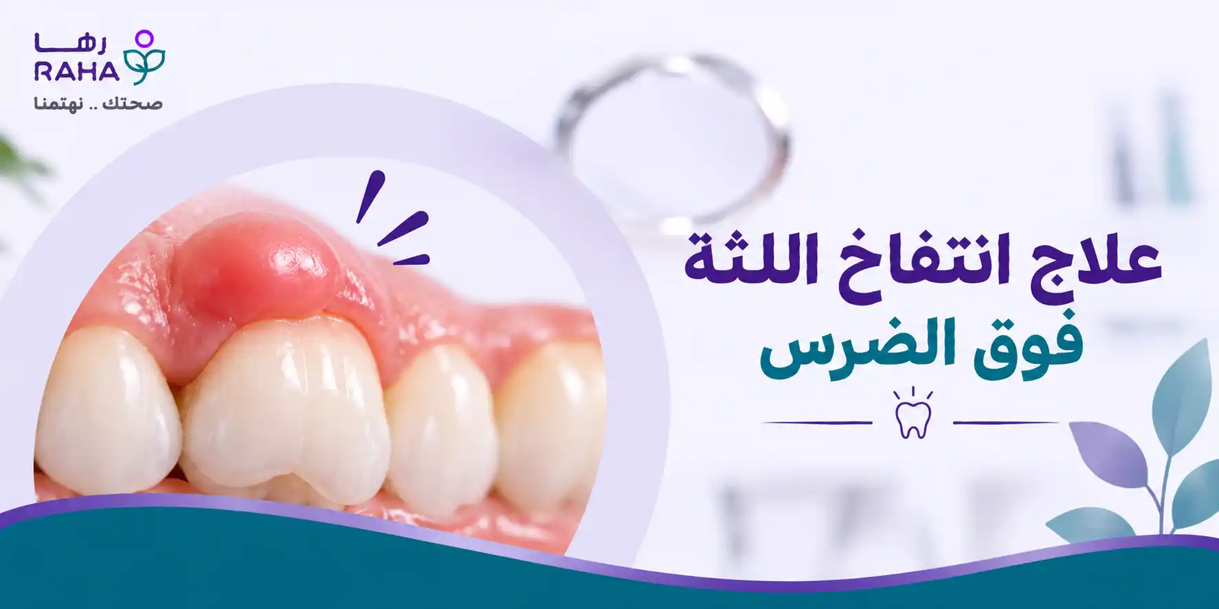 علاج انتفاخ اللثة فوق الضرس | الأسباب والعلاج ومتى تحتاج الطبيب