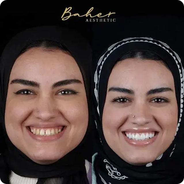 before-after-face