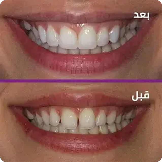 before-after-teeth